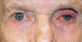 Medsafe: Bệnh lý về mắt liên quan đến prostaglandin